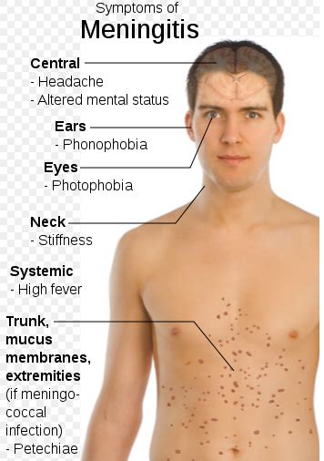 meningitis b symptoms